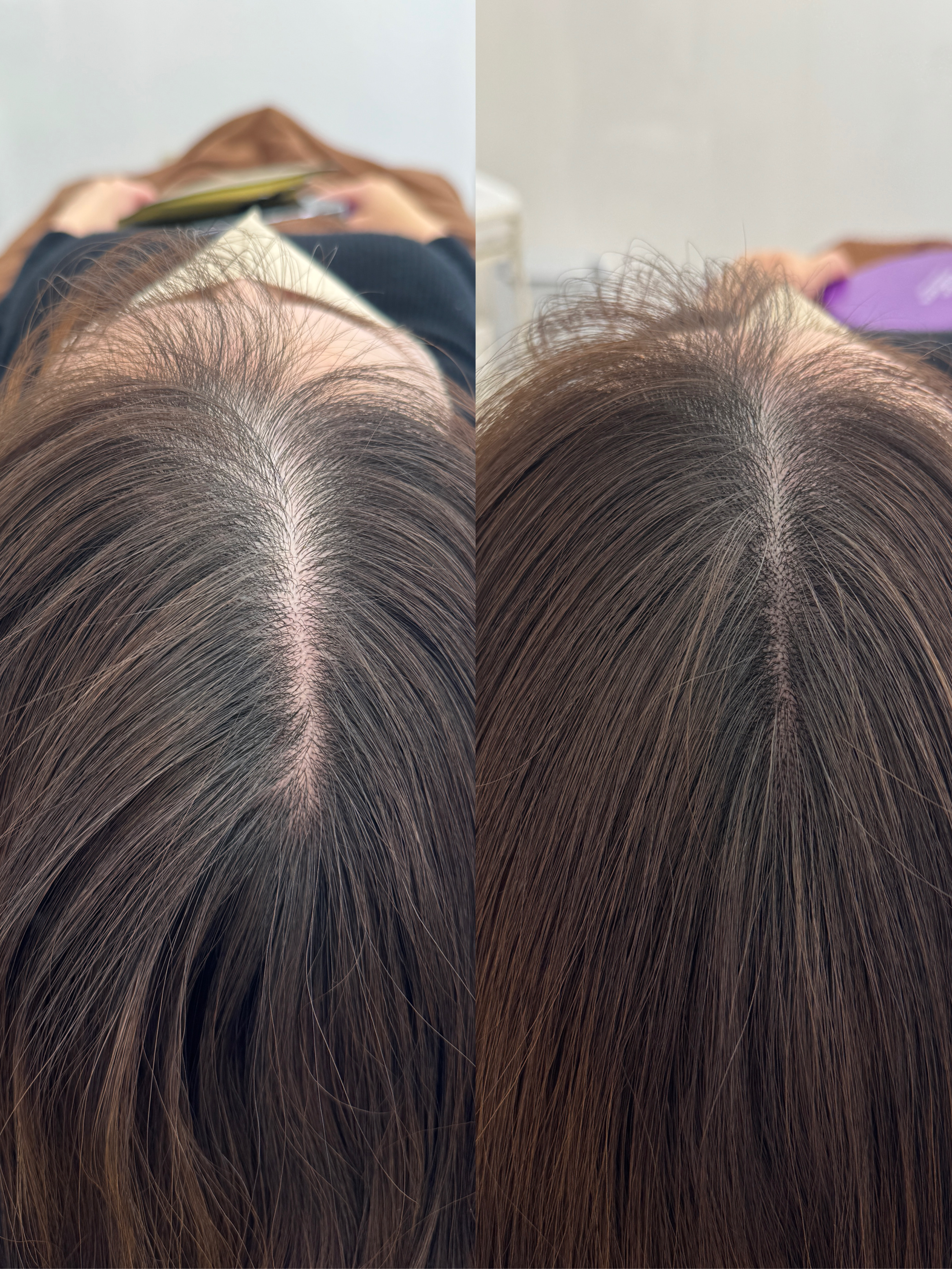 ヘアスカルプアートメイクの症例イメージ